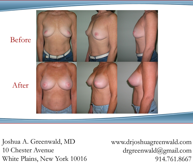 breast implants photos. reast-implants-before-after