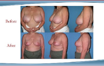 White Plains Breast Reduction and Breast Lift