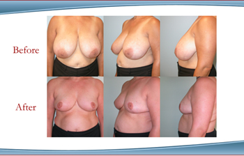 New York BReast Reduciton and Breast Lift