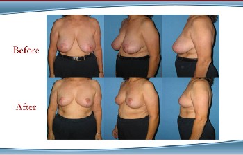 Westchester New York BReast Reduciton and Breast Lift