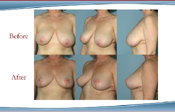 Westchester County New York BReast Reduciton and Breast Lift