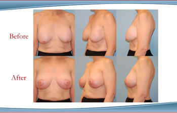 Westchester County New York breast Lift & Augmentation