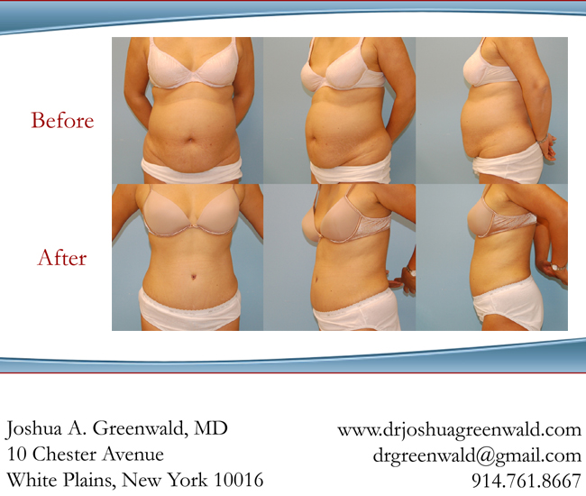 Before and After Tummy Tuck Photos New York Westchester County