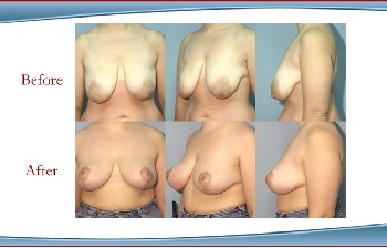 Manhattan Breast Lift and Breast Augmentation