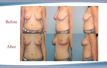 Westchester County Breast Lift & Mastopexy