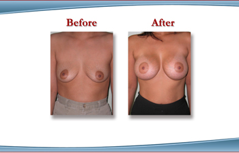 White Plains Breast Augmentation