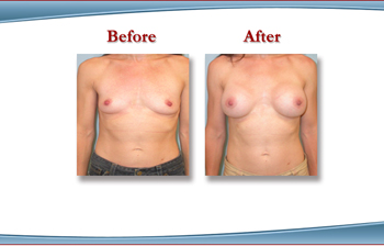 White Plains  Breast Augmentaiton with Breast Implants