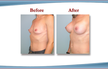 New York Breast Augmentaiton with Breast Implants