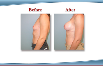 Westchester County  Breast Augmentaiton with Breast Implants