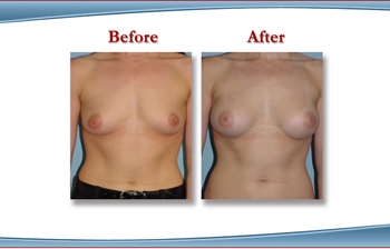 Westchester County  Breast Augmentaiton with Breast Implants