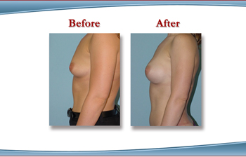 White Plains Breast Augmentaiton with Breast Implants
